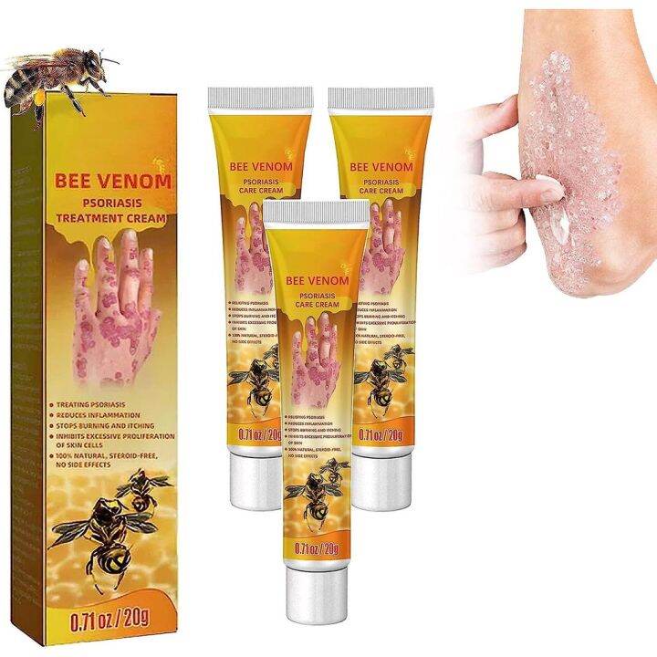 Bee Venom Psoriasis Treatment Cream, 20g New Zealand Bee Venom ...