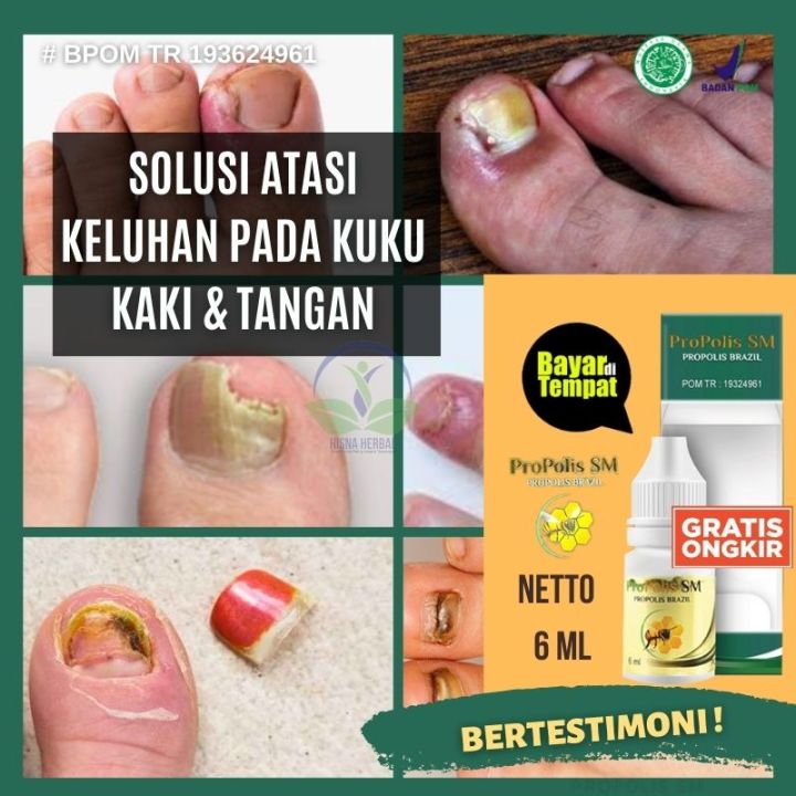 Obat Kuku Cantengan Kuku Rusak Parah Borok Gatal Jamur Kuku Kering