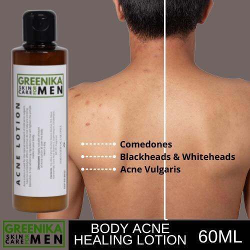 [ ACNE LOTION FOR MEN ] Greenika For Men Body Acne Healing Lotion