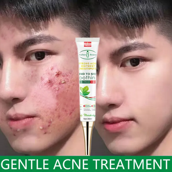 Acne Removal Cream Remove Pimple Scar Herbal Spots Oil Control G 秀逸