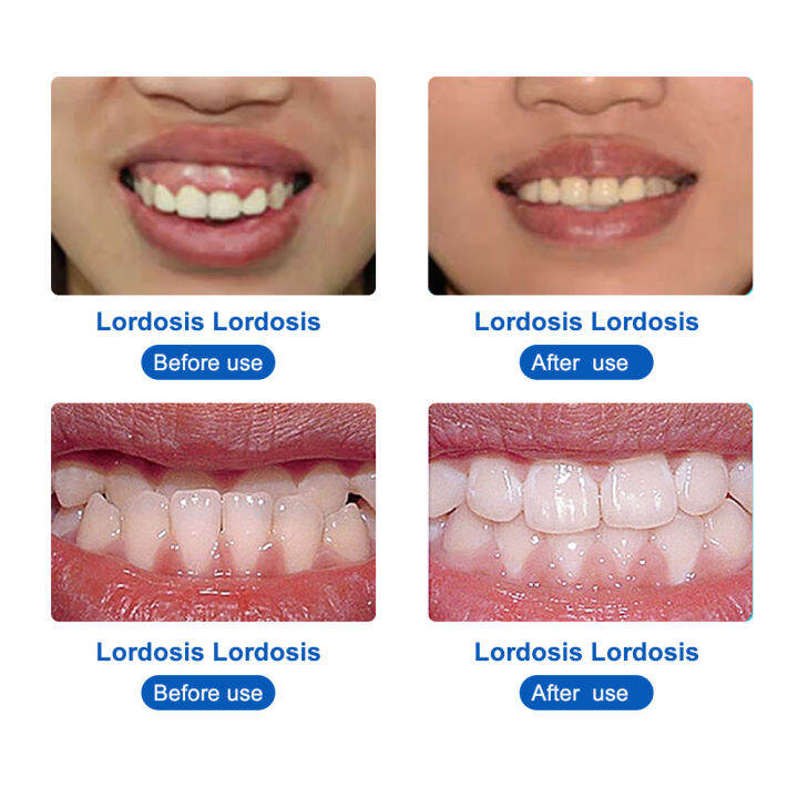 เฟส1-2-cofoe-4d-ที่มองไม่เห็นจัดฟันการจัดตำแหน่งอุปกรณ์การจัดตำแหน่งโปร่งใสวงเล็บ-guard-anti-wear-ฟรีกล่องพกพา