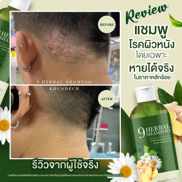 หนังศรีษะแห้ง ราคาถูก ซื้อออนไลน์ที่ - ก.ค. 2023 | Lazada.Co.Th