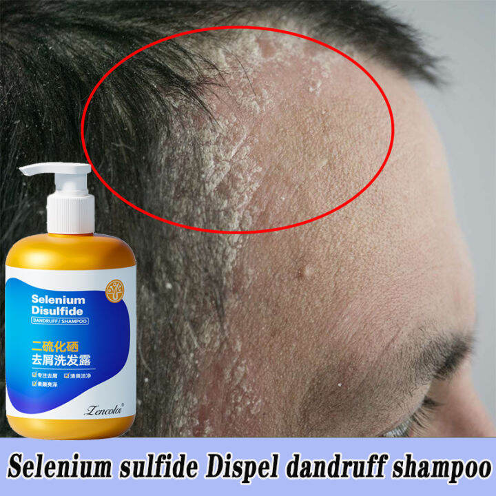 AntiDandruff Shampoo Selenium Disulfide Antiitch shampoo Remove scalp