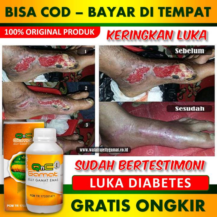 Obat Pengering Luka Diabates Basah Bernanah Gangren Luka Jadi Lebih Cepat Kering Dan Rapat 4873