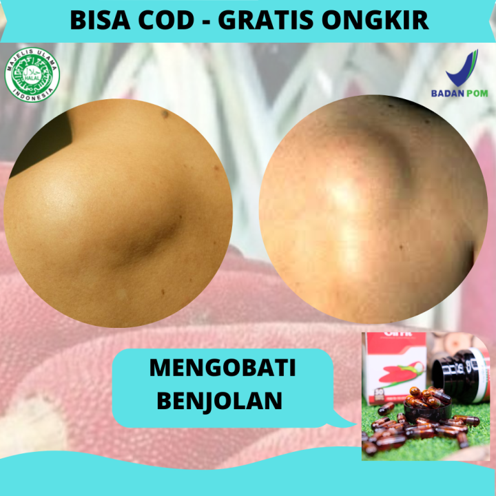 Obat Benjolan Di Pundak, Mengecilkan Lipoma Di Belakang Leher, Bahu ...