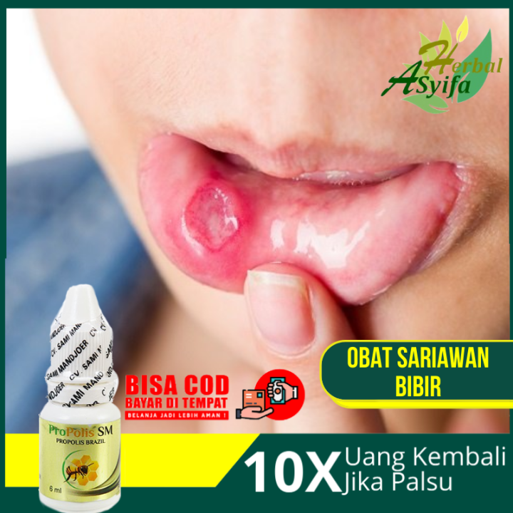 Obat Sariawan Bibir Obat Sariawan Di Luar Bibir Obat Sariawan Mulut Herbal Mengatasi