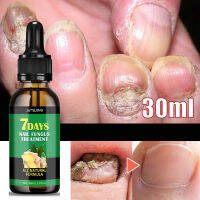 7วันขิงเล็บเชื้อรารักษา Feet Care Essence Anti การติดเชื้อ Paronychia Onychomycosis Foot Toe เล็บเชื้อราเจลกำจัด