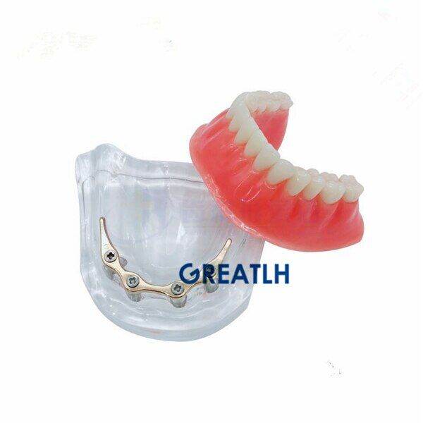 overdenture-implant-model-denture-teeth-mandibular-model-with-golden-bar-dental-teaching-model