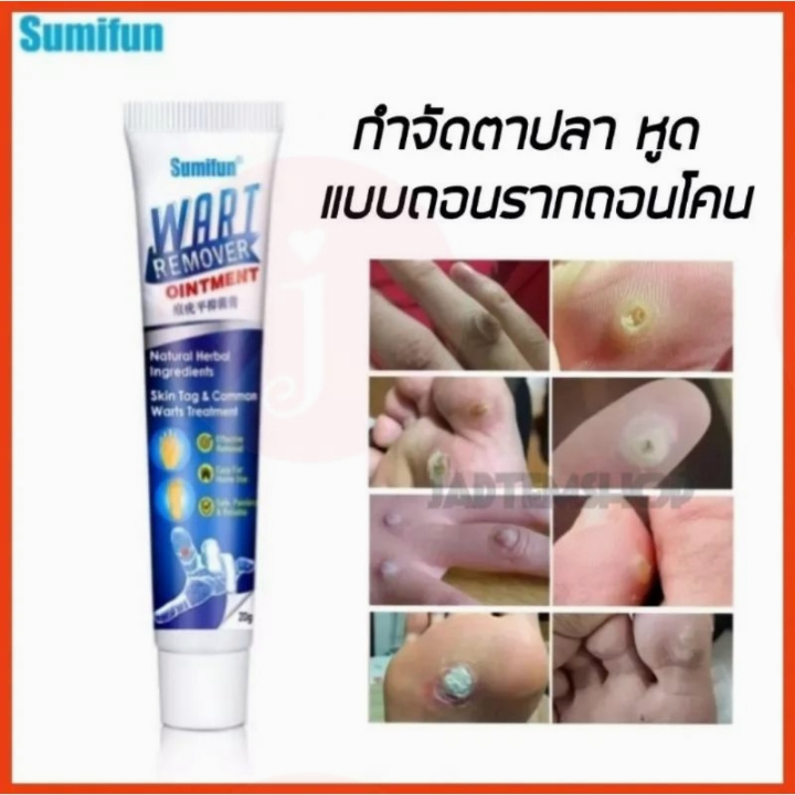 Sumifun Cream for Removing Warts, Polyps and Fish Eyes, 20g, Free! Skin