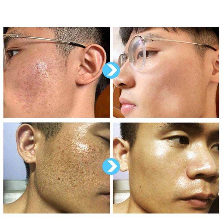 Whitening Freckle Cream Effective Remove Melasma Acne Dark Spots Fade