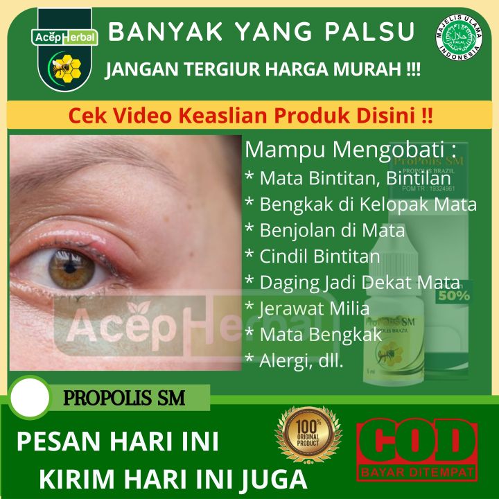 Obat Penghilang Mata Bintitan Sakit Mata Bintitan Mata Bintitan Anak ...