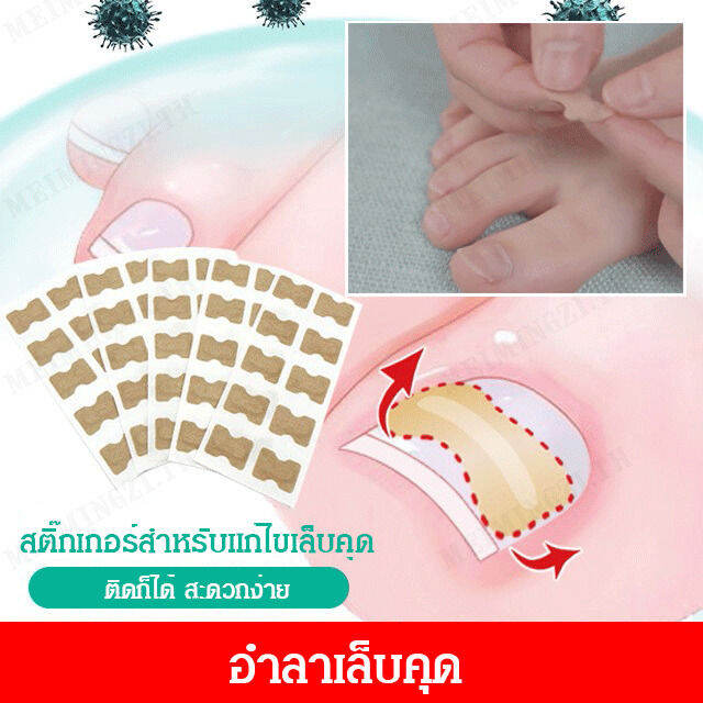 meimingzi-ชุดสติ๊กเกอร์สำหรับแก้ไขเล็บคุด