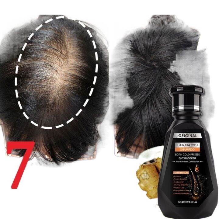 PEIMEI ginger shampoo hair grower growth horse ng kabayo ketoconazole