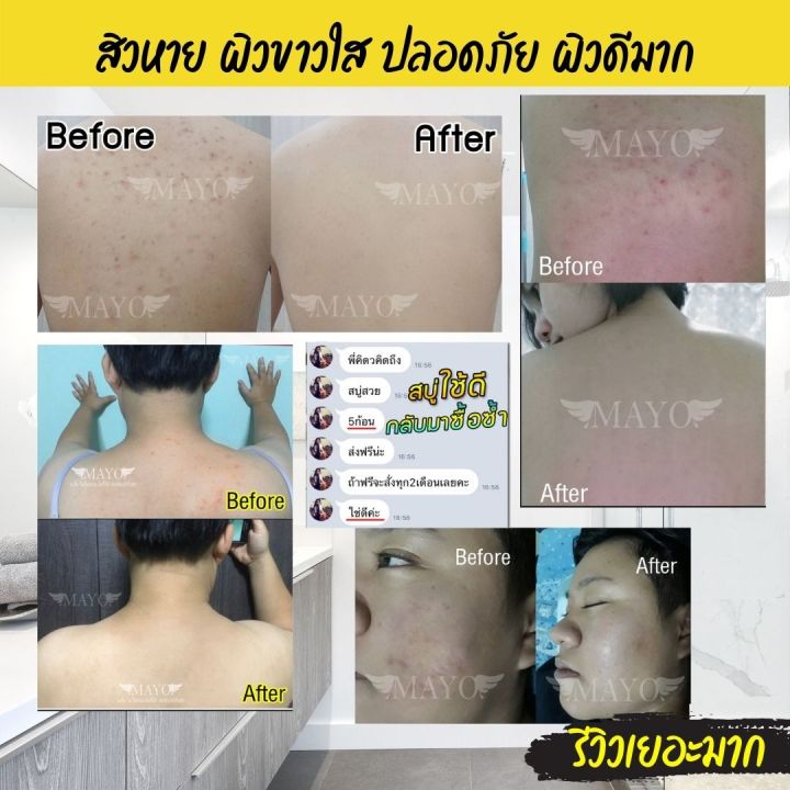 ส่งฟรี-สั่งเลย-สบู่ลดสิว-สูตรอ่อนโยน-เมโย-สบู่สมุนไพร-ลดรอยสิว-แถมฟรีถุงตีฟองทุกก้อน-ลดสิว-สบู่-ปราบสิว-อันดับ1-ผิวแพ้ง่ายใช้ได้-mayo