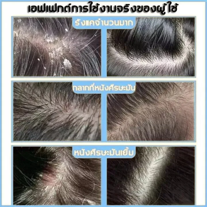 ขจัดเหาถึง100-แชมพูกำจัดเหา-120ml-กำจัดถึงต้นตอ-เหาตาย-ไข่หลุด-แก้คัน-สมุนไพร100-แชมพูเด็ก-ยากำจัดเหา-กำจัดเหา-ไข่เหา-กลิ่นหอม-อ่อนโยน-ยาฆ่าเหา-แชมพูเหา-ยาฆ่าเหาถาวร-กำจัดเหา-บรรเทาอาการคัน-ยาฆ่าเหาถา