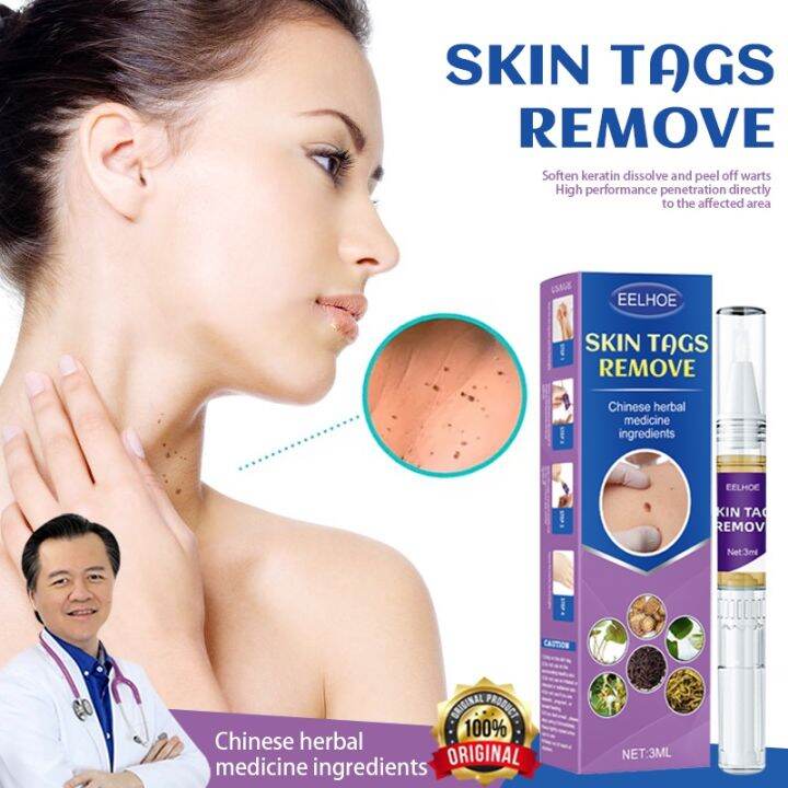 warts remover original kasoy oil cream warts removal skin tag wart ...