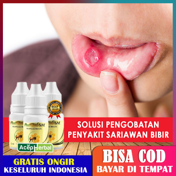 Obat Sariawan Di Bibir Mulut Lidah Atasi Bau Mulut Tak Sedap Bibir Pecah Pecah Panas Dalam