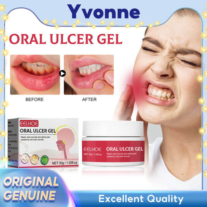 EELHOE Oral Ulcer Gel Relieve Swollen Gum Gel Oral Care Pain Relief