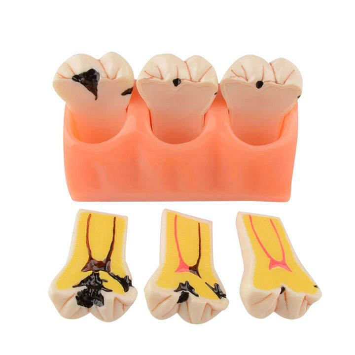 Dental Decayed Tooth Model Denture Caries Disease Tooth Model
