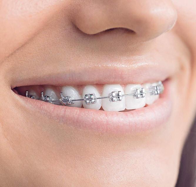 oral-b-ortho-care-essentials-หัวแปรงสีฟันไฟฟ้าสำหรับผู้ที่จัดฟัน-made-in-germany