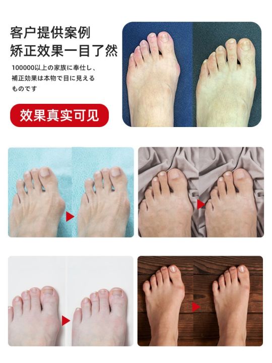 japanese-toe-corrector-hallux-valgus-corrector-big-female-toe-valgus-corrector-toe-splitter-orthopedic-artifact