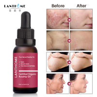 1Pc Moisturizing Anti-acne Essential Liquid Rosehip Oil Face Body Serum Lighten Acne Print Scars Acne Spots Marks Skin Care Soap