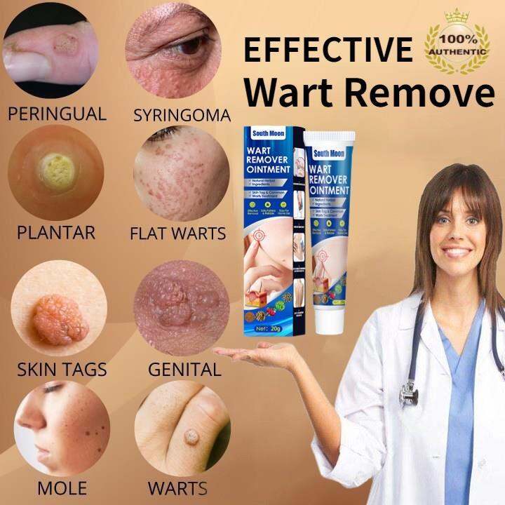 free shopping warts remover original☋ ☽ Warts Remover Original Cream Genital Herpes Condyloma