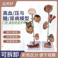 Human medicine eye heart kidney blood vessels from the complications of diabetes foot department recovery pathological presentation model