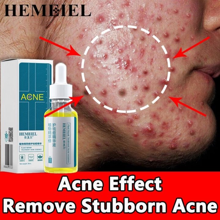 HEMEIEL Acne Treatment Pimple Remover/Face Serum Anti Acne Scar Marks