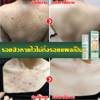 บรรเทาอาการคันผิวหนัง Jaysuing 120ml สิวที่หลัง  ลดไรและสิวตามร่างกาย แอคเน่ สเปรย์ฉีดแผ่นหลังและลำตัว  กำจัดสิวที่หลังและลำตัว ครีมแต้มสิว