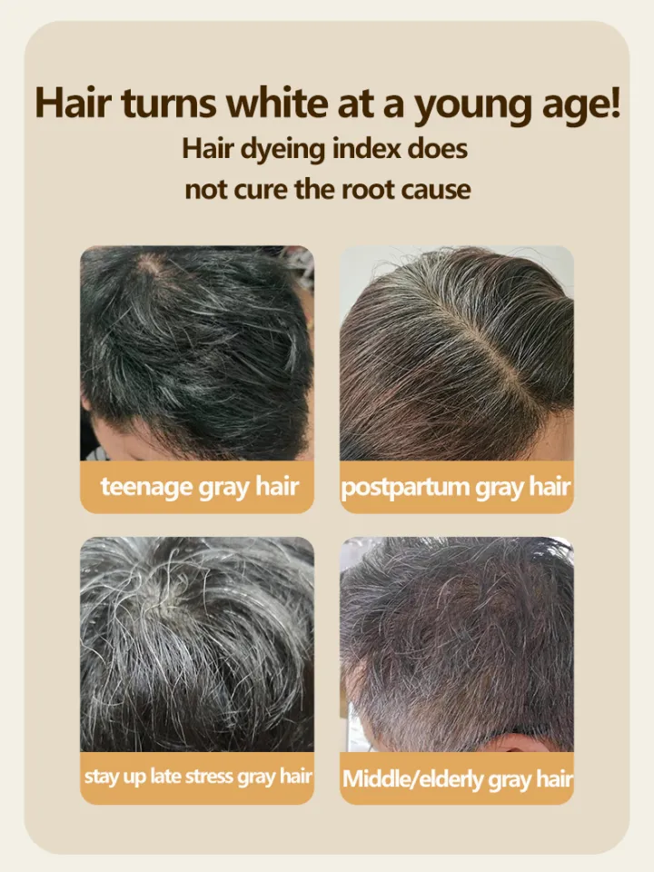 Share more than 139 why hair turns white latest ceg.edu.vn