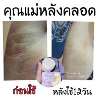 ครีมทาง่ามขาแอนนา ครีมทาง่ามขา ครีมทาข้อศอก ครีมทาก้นดำ X1 กระปุก 30 g