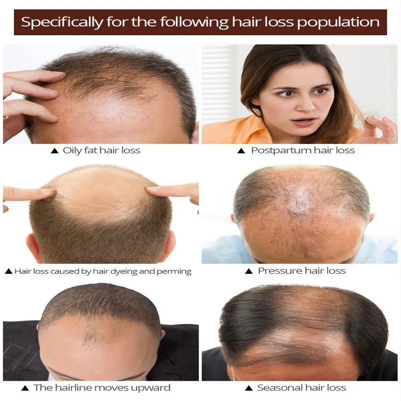 💦 100% natural ginger💦Hair Grower Serum Hair Grower Castor Oil Hair Growth Spray Essence ginger essence Hair Grower Fast Long Hair Hair Treatment anti Hair Loss Serum Minoxidil Preventing Baldness Consolidate Hair 💦 100% natural ginger💦Hair Grower Serum Hair Grower Castor Oil Hair Growth Spray Essence ginger essence Hair Grower Fast Long Hair Hair Treatment anti Hair Loss Serum Minoxidil Preventing Baldness Consolidate Hair