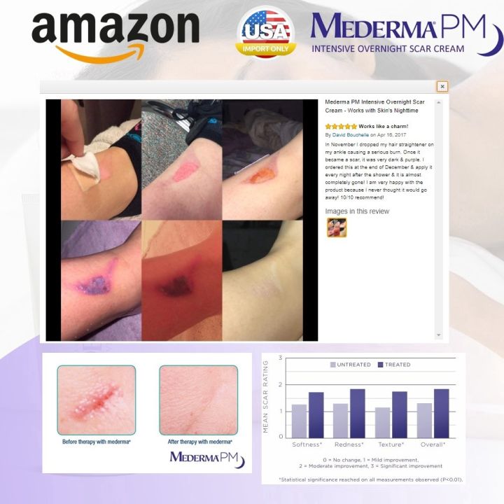 ครีมลดรอยแผลเป็น-mederma-pm-intensive-overnight-scar-cream-1oz-รักษาแผลเป็น-เห็นผลดีที่สุด
