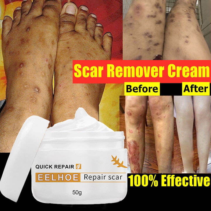 Original scar remover for old scar on leg Peklat Remover Cream for Old 50g Peklat Stretch Mark