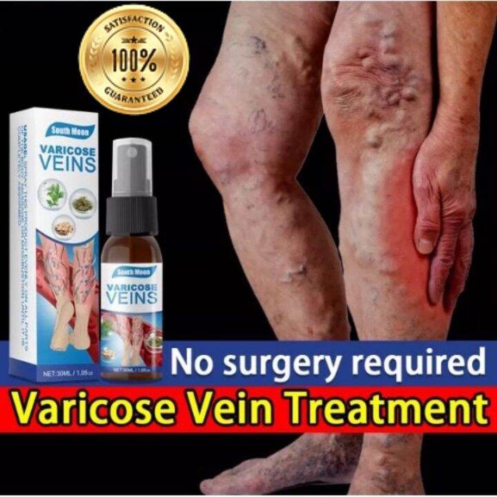 Hot ! varicose vein massage varicose activating spray to remove scar cream varicose vein spider