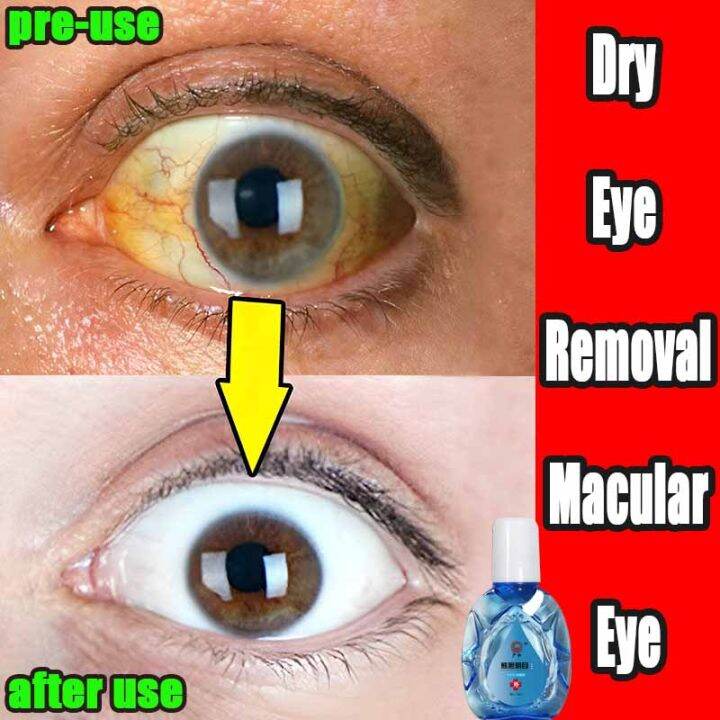 眼睛干涩眼药水 Eye Problems Therapy Eye Drops myopia astigmatism improvement