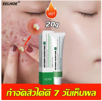 กำจัดสิว 20ML ลดสิวเสี้ยนครีมรักษาสิว สลายสิวอุดตันที่ต้นตอ อ่อนโยนและไม่ระคาย ครีมลดสิว ครีมกำจัดสิว เจลแต้มสิว