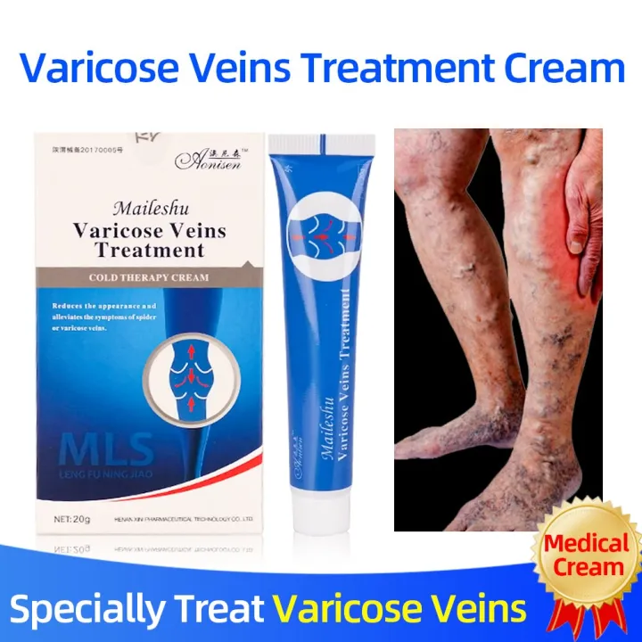 Varicose veins Treatment Cold Compress Cream Treatment Varicose