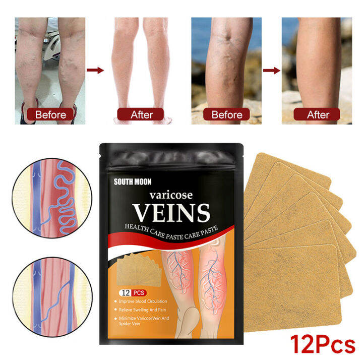 100% Effective Varicouse Vein Patch (12pcs 1pack) Relieve swelling of ...