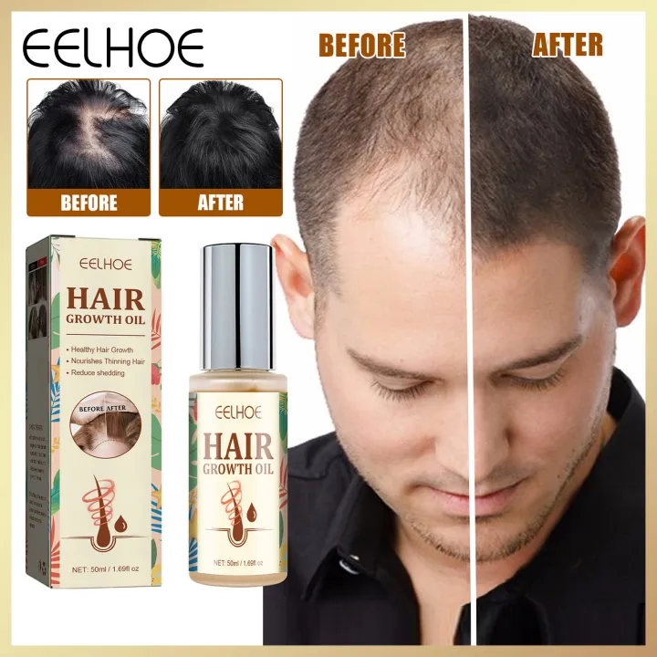 Eelhoe Hair Growth Oil Hair Growth Essential Oil Natural Anti Hair Loss ...