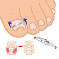 1 ชุดเครื่องมือแก้ไขเล็บคุด Toenail Straightening Correctors Patch ชุดเครื่องมือเล็บ Repairer Orthosis เครื่องมือความงาม