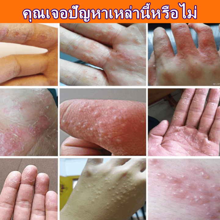 ครีมทามือแตก-ยาทามือแห้งแตก-แฮนด์ครีม-ครีมทามือน้ำมันม้า-ครีมทามือลอก-ช่วยแก้ไขปัญหาผิวหนัง-แห้งหร้าน-ผิวลอก-บำรุงผิวมือ-hand-cream