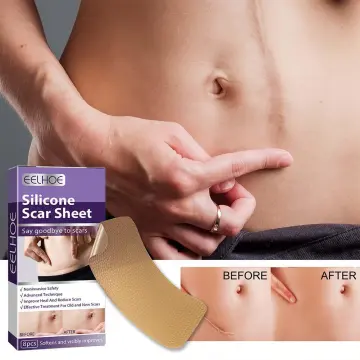 3 Pack Silicone Scar Sheets,Medical Grade Soft Silicone Scar Tape, Strips, Roll - Scars Removal Treatment,8Pcs/Pack, Size: One size, Other