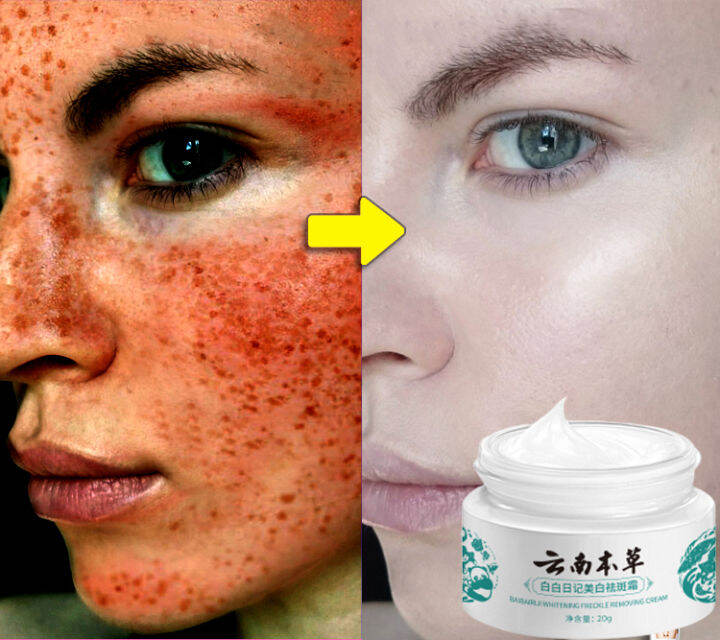 7days Whitening Japanese Melasma Cream Yunnan Herbal Whitening Freckle