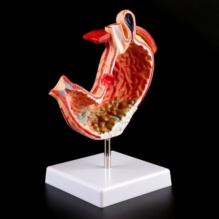 human-anatomical-anatomy-stomach-medical-model-gastric-pathology-gastritis-ulcer-medical-teaching-learning-tool