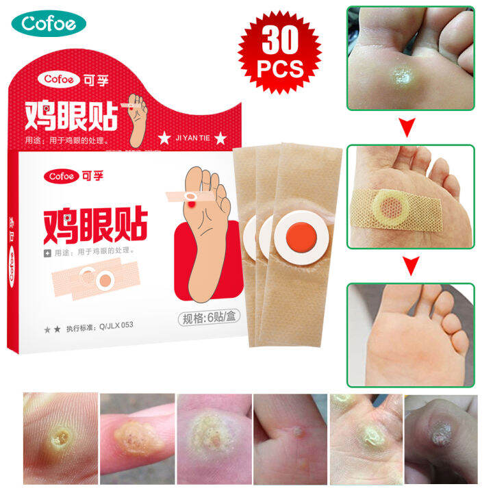 Cofoe Medical Foot Corns Remover Patch Skin Tag Feet Warts Removal