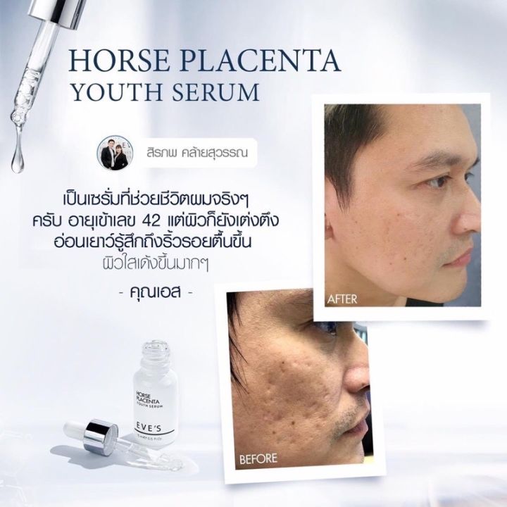 เซรั่มรกม้า-เซรั่มหน้าเด็ก-horse-placenta-eves-อีฟส์แท้100