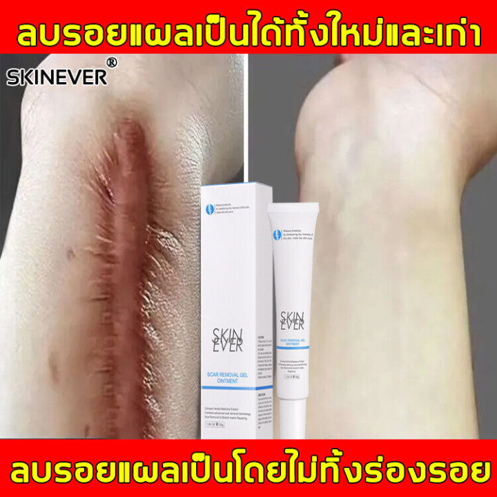 ขายดี-ever-สมุนไพร-soothing-gentle-ยากำจัดแผลเป็นเจลครีม30g