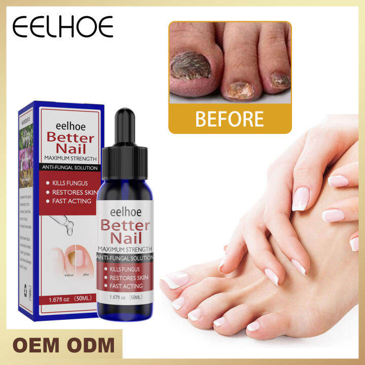 100% ORIGINAL 【Effective in 5 days】Nail fungus repair Nail repair ...